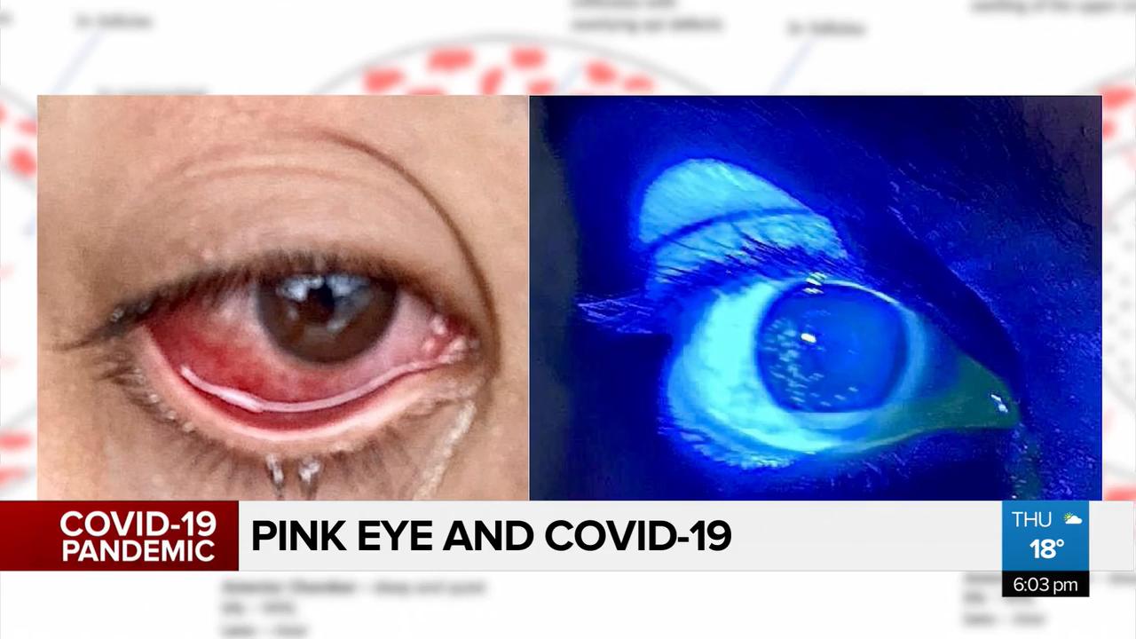 Pink eye a less common symptom of COVID19 Video CityNews Edmonton